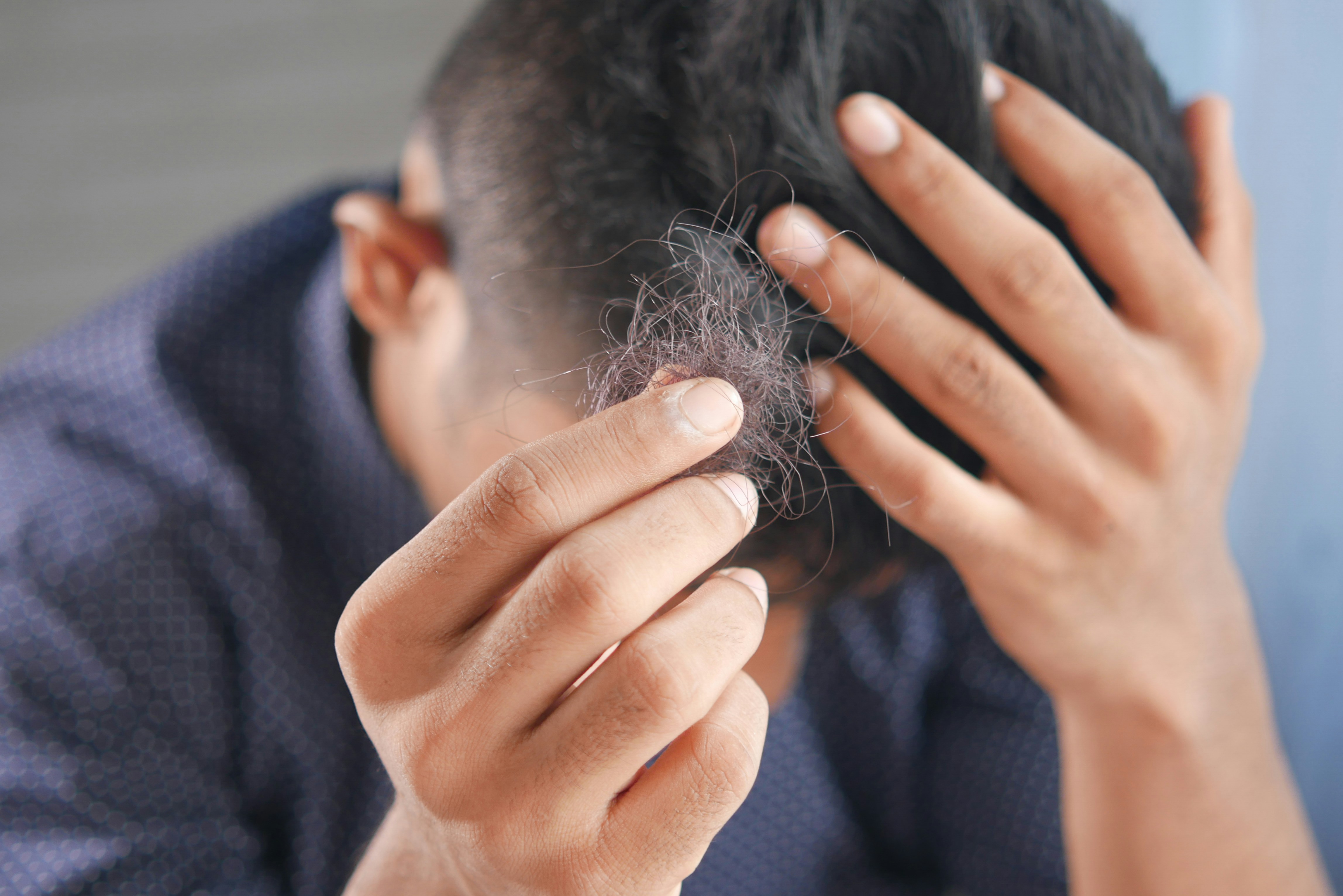 Why Is Hair Loss Common After COVID?